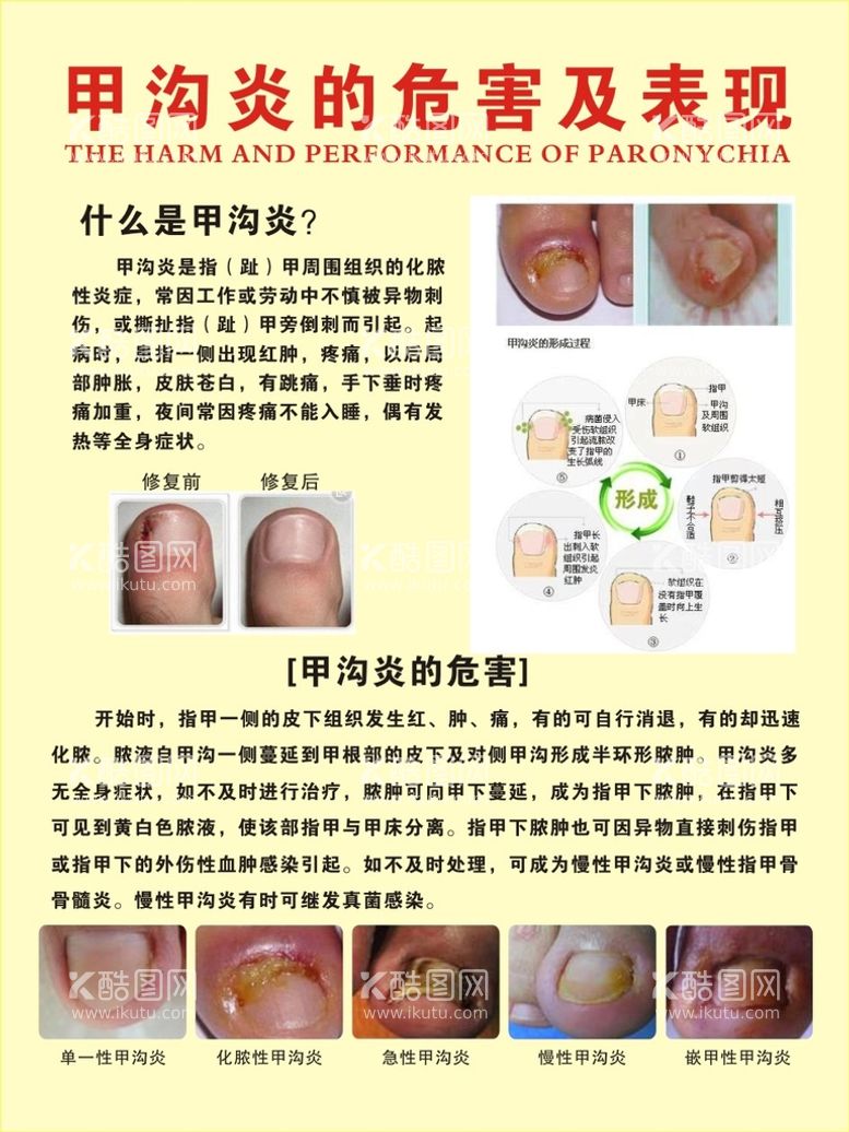 编号：13145112061029225027【酷图网】源文件下载-甲沟炎展板