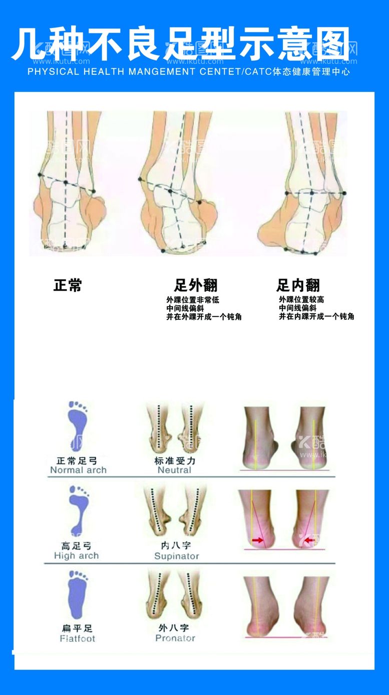 编号：34435410160417066183【酷图网】源文件下载-几种不良足型示意图