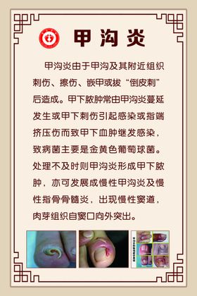 甲沟炎手足护理中心