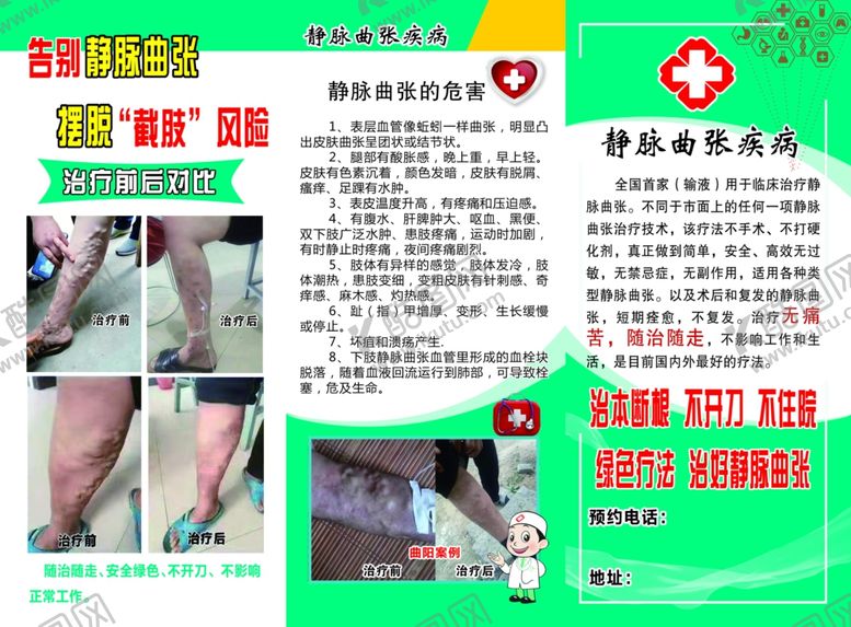 编号：22896206271841427196【酷图网】源文件下载-静脉曲张