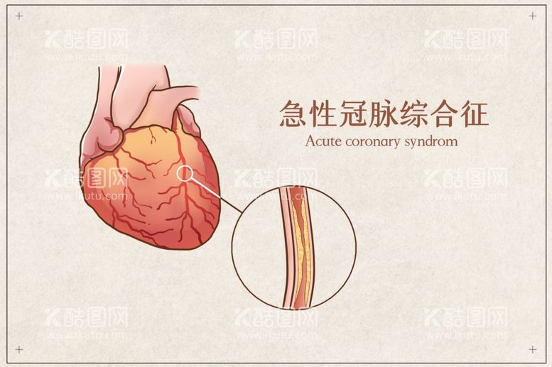 编号：58637612020630046854【酷图网】源文件下载-急性冠脉综合症