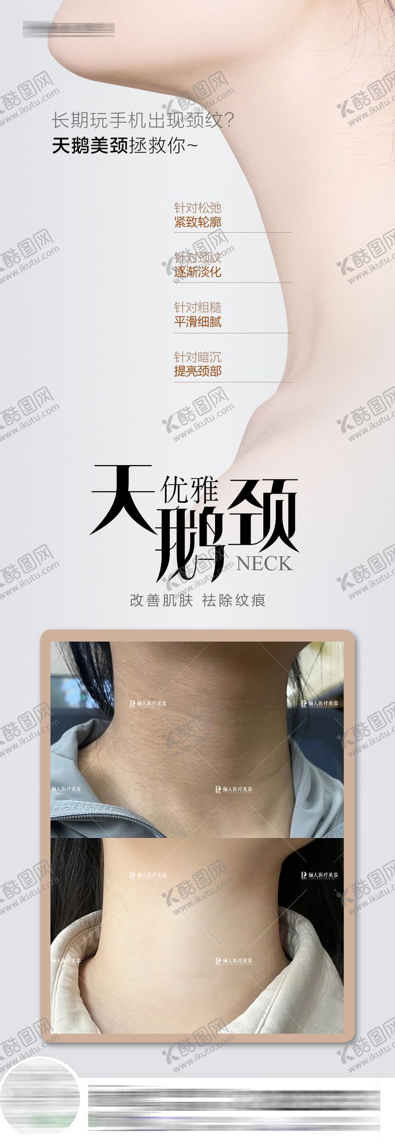 编号：31352612031925319170【酷图网】源文件下载-医美天鹅颈祛颈纹案例长图