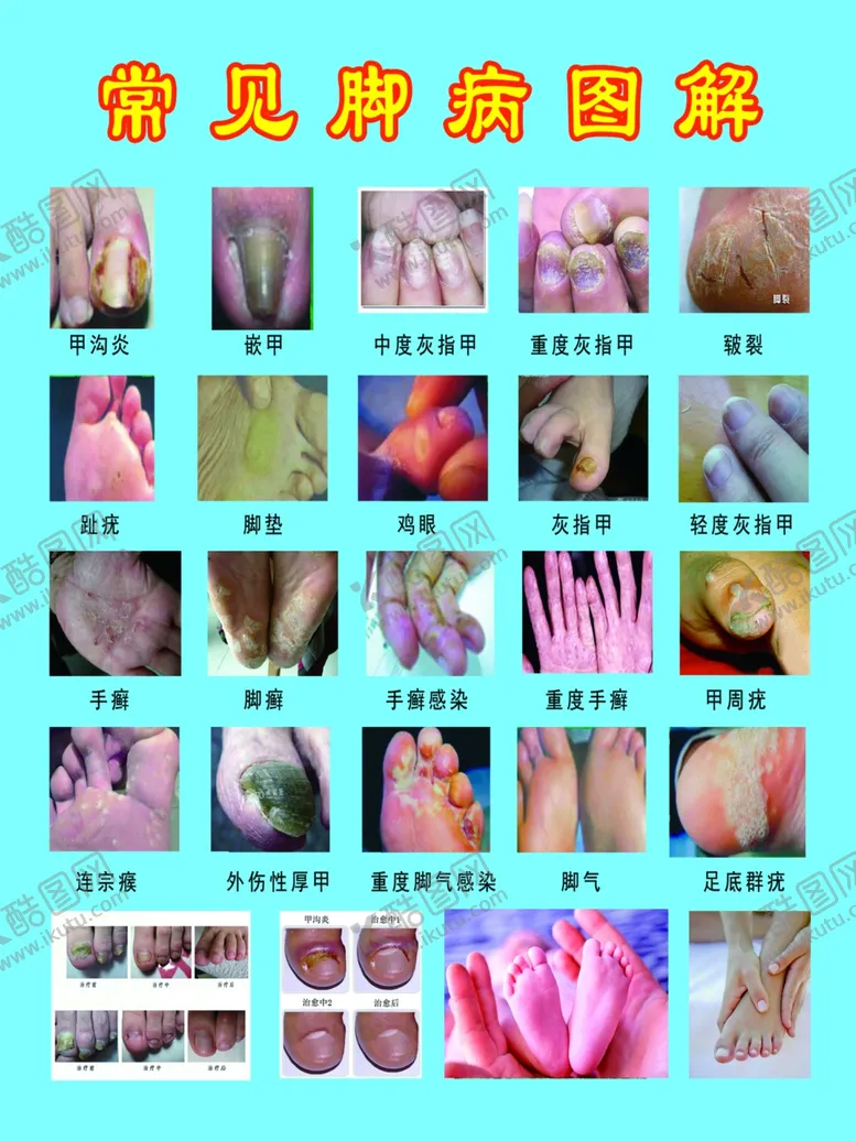 编号：62831212071827096196【酷图网】源文件下载-常见脚病图解