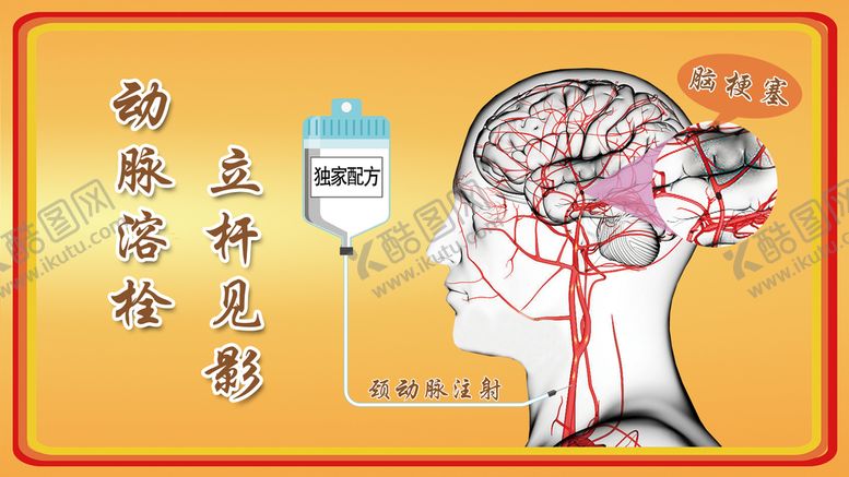 编号：68145709211203440217【酷图网】源文件下载-动脉溶栓图