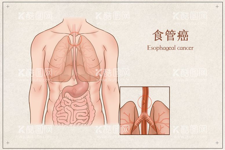 编号：32470810080337031074【酷图网】源文件下载-食管癌