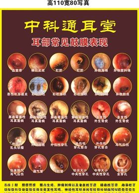 常见鼓膜表现症状图灯箱