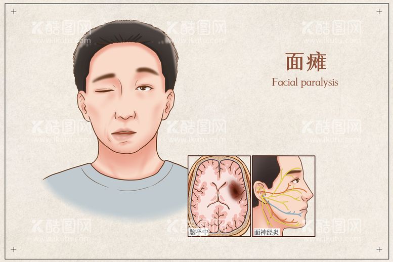 编号：83529409131327015490【酷图网】源文件下载-面瘫