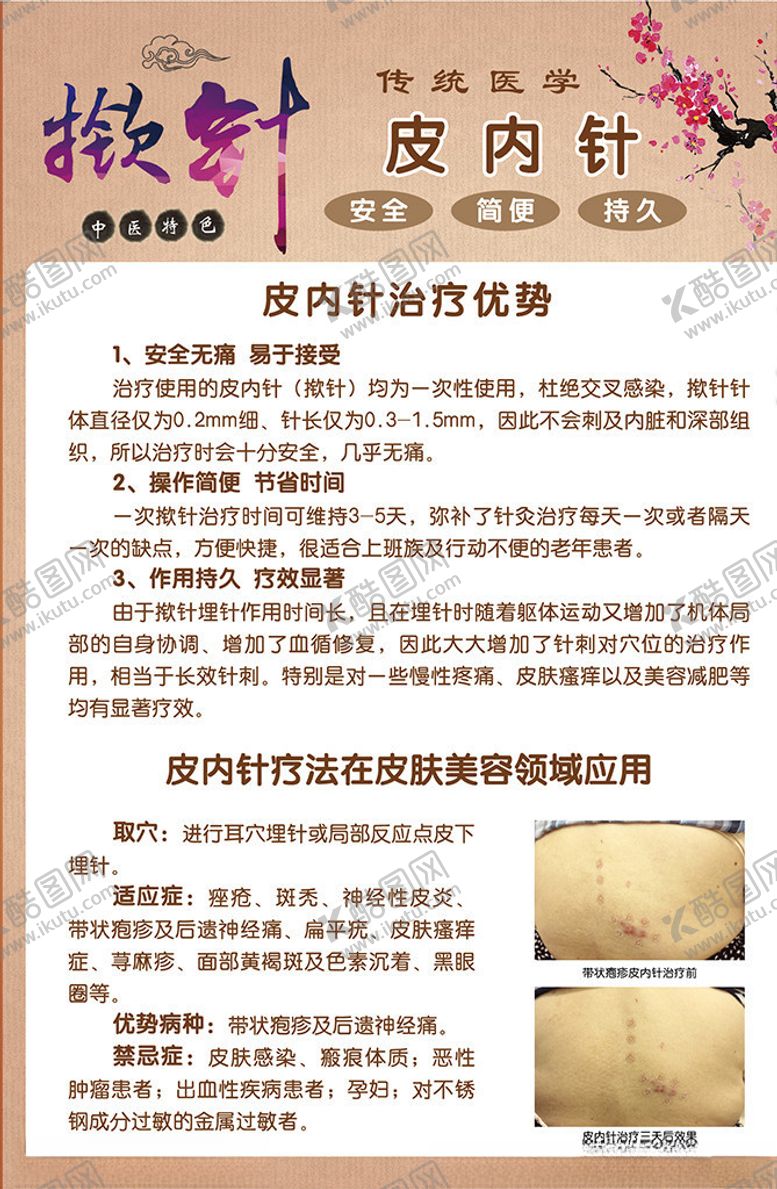 编号：10137310032239491551【酷图网】源文件下载-皮内针揿针