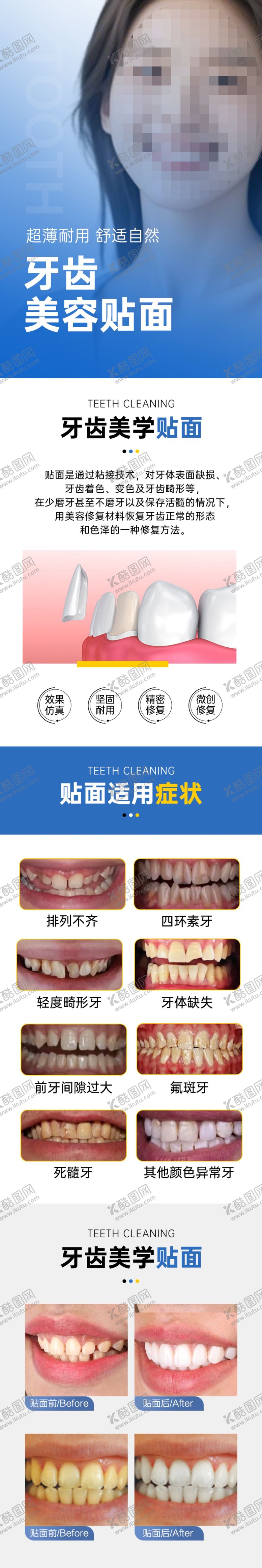 编号：89450504070040463898【酷图网】源文件下载-牙齿美白贴面