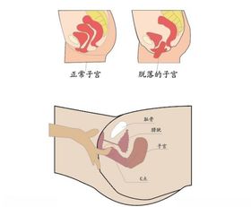 子宫脱垂矢量图