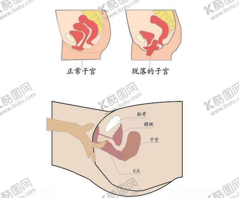 编号：18829307131553051829【酷图网】源文件下载-子宫脱垂矢量图