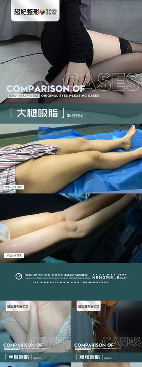 医美腰腹大腿手臂吸脂案例