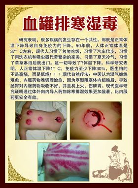 血罐排寒湿毒宣传板