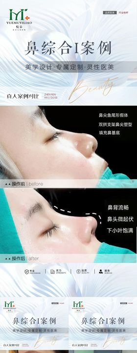 眼整形案例海报