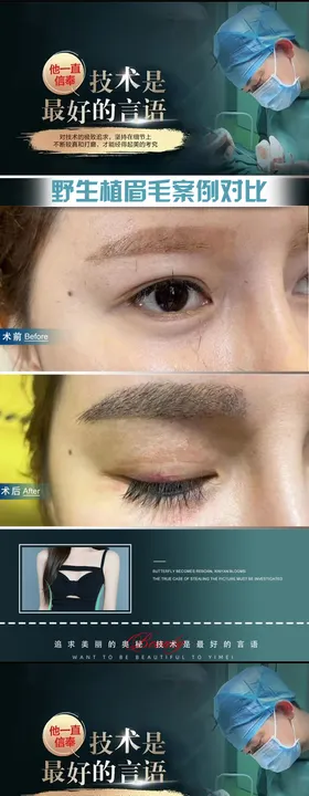 整形植发医生案例海报