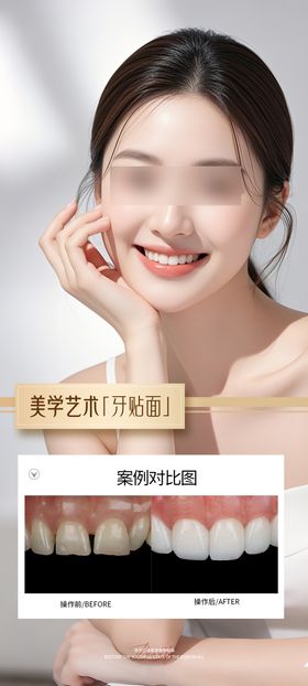 牙贴面案例