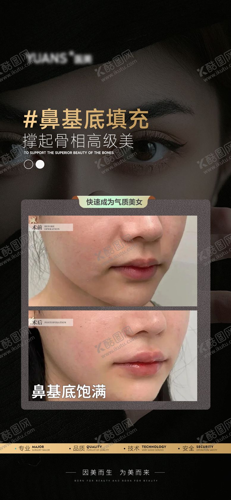 编号：82456402250605206312【酷图网】源文件下载-医美鼻基底填充案例对比