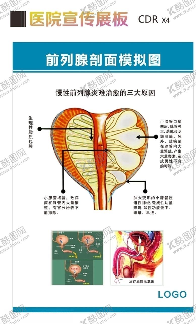 编号：92234405061619273820【酷图网】源文件下载-前列腺剖面模拟图