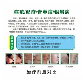 痤疮介绍
