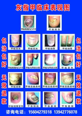 灰指甲