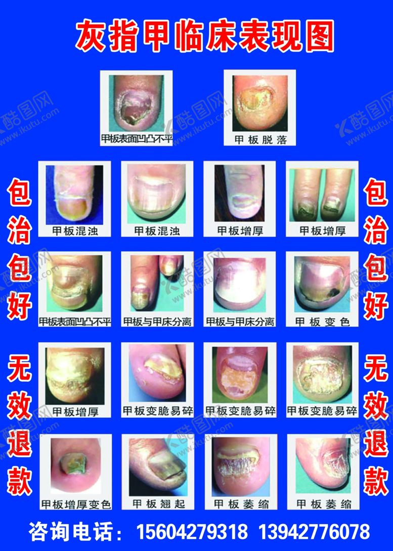编号：92493007030144587047【酷图网】源文件下载-灰指甲