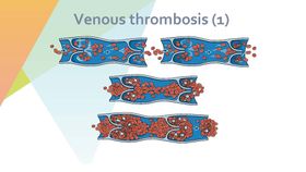 静脉血栓