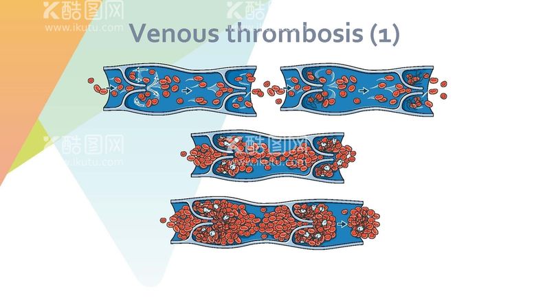编号：51543911150208092065【酷图网】源文件下载-静脉血栓