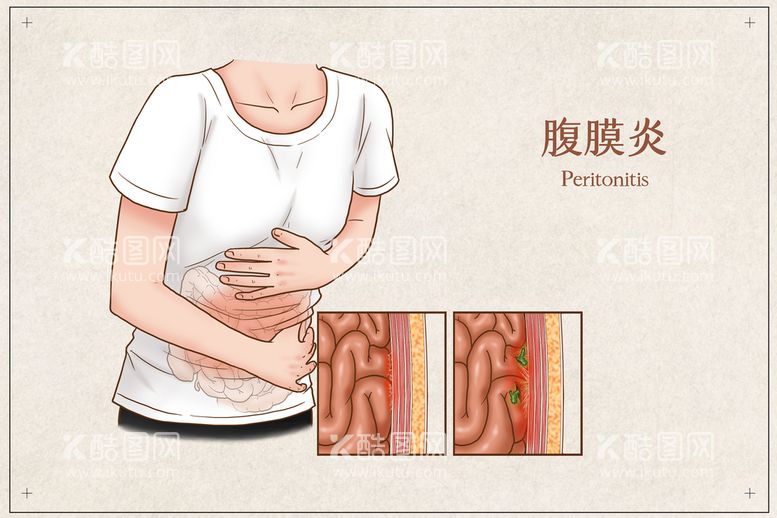 编号：81775110190040372371【酷图网】源文件下载-腹膜炎