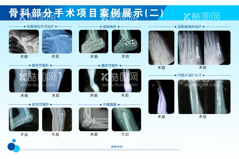 编号：13297410120251197536【酷图网】源文件下载-骨科部分手术项目案例展示