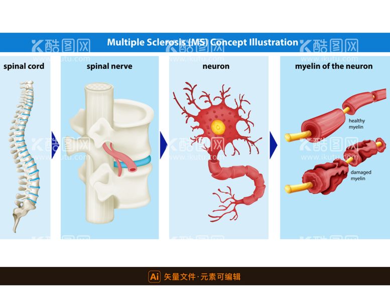 编号：54906809291428388953【酷图网】源文件下载-医学多发性硬化插画