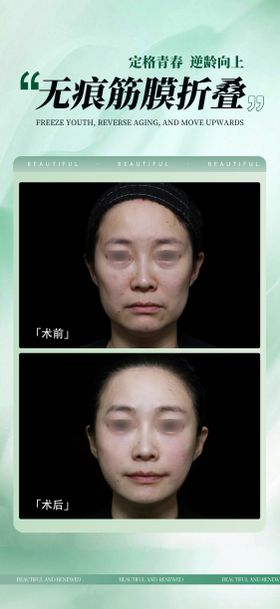 筋膜固定小拉皮提升悬吊术海报
