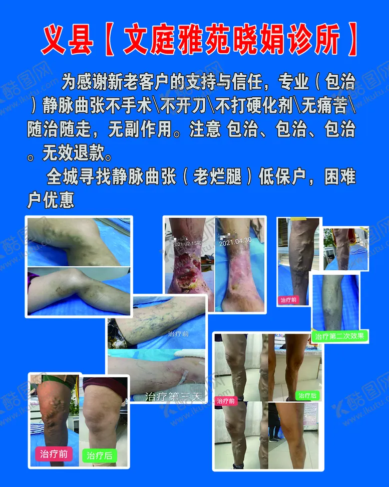 编号：12563009211706194695【酷图网】源文件下载-静脉曲张