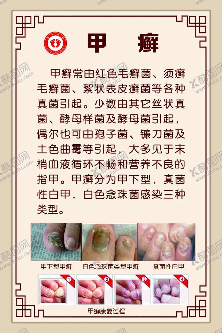 编号：28444005092028167532【酷图网】源文件下载-甲癣