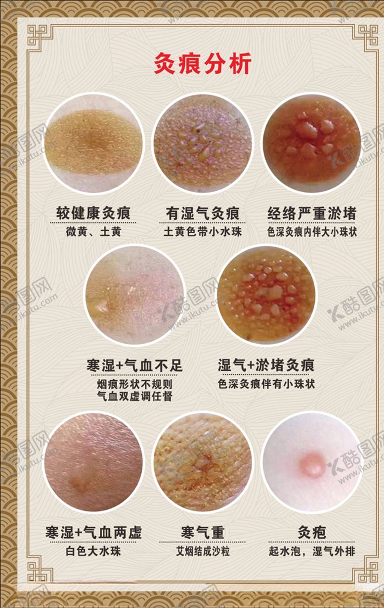 编号：45818009142301425884【酷图网】源文件下载-灸痕分析