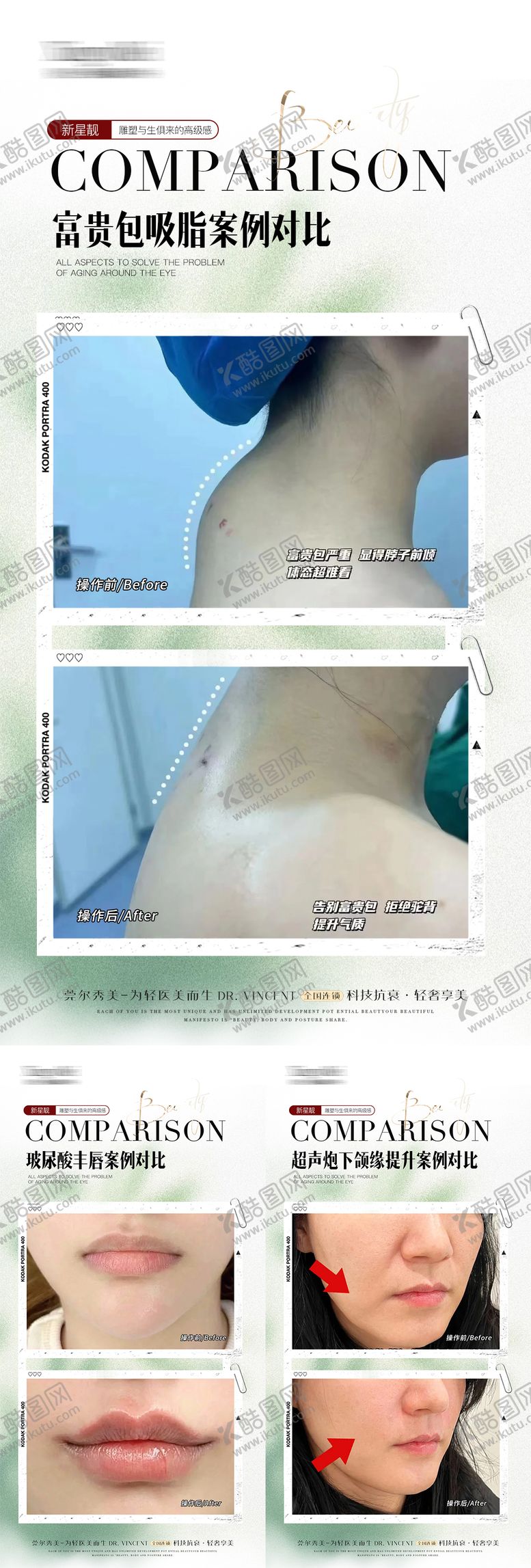 编号：17564812101744086178【酷图网】源文件下载-微整案例