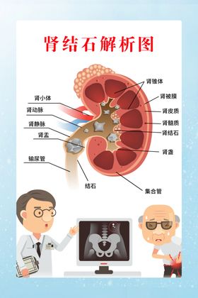 肾结石