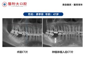 口腔/种植牙案例专家海报