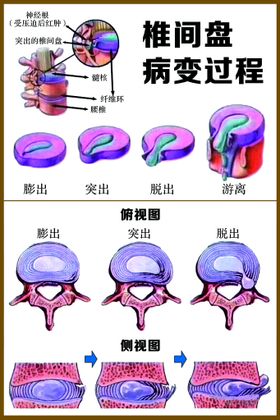 编号：59732809250600414839【酷图网】源文件下载-椎间盘常见病变