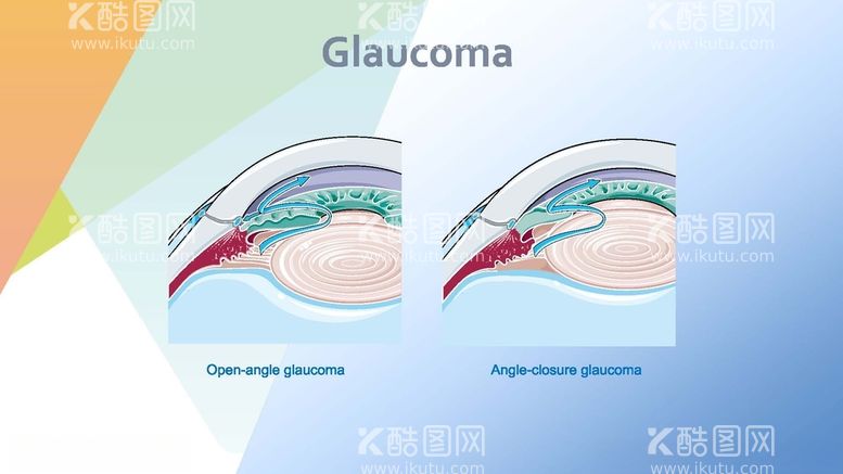 编号：55258212160401373453【酷图网】源文件下载-青光眼