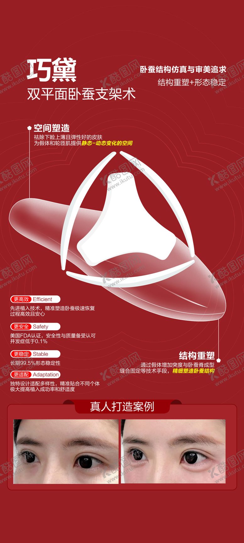 编号：84890401252214455071【酷图网】源文件下载-双平面卧蚕支架术