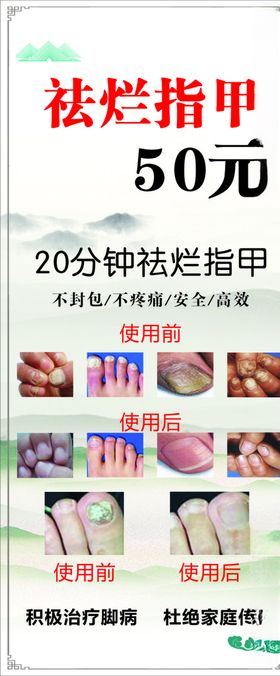 灰指甲展架