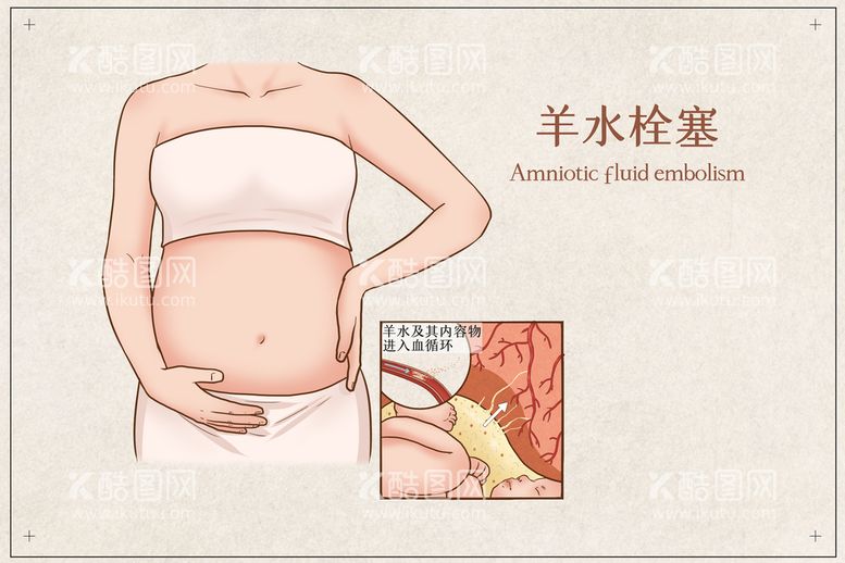 编号：13312110182038052826【酷图网】源文件下载-羊水栓塞