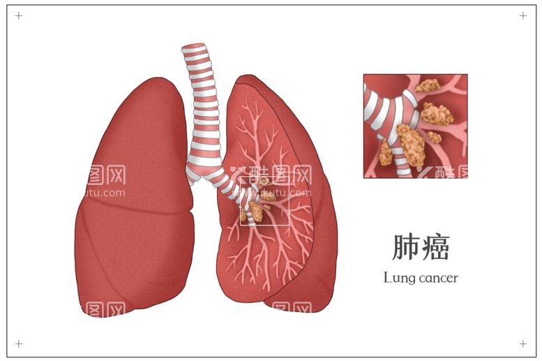 编号：57304112131536255826【酷图网】源文件下载-肺癌