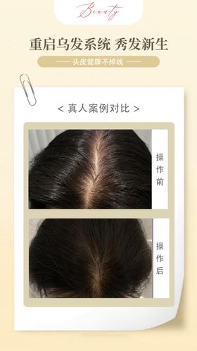 头皮抗衰案例海报