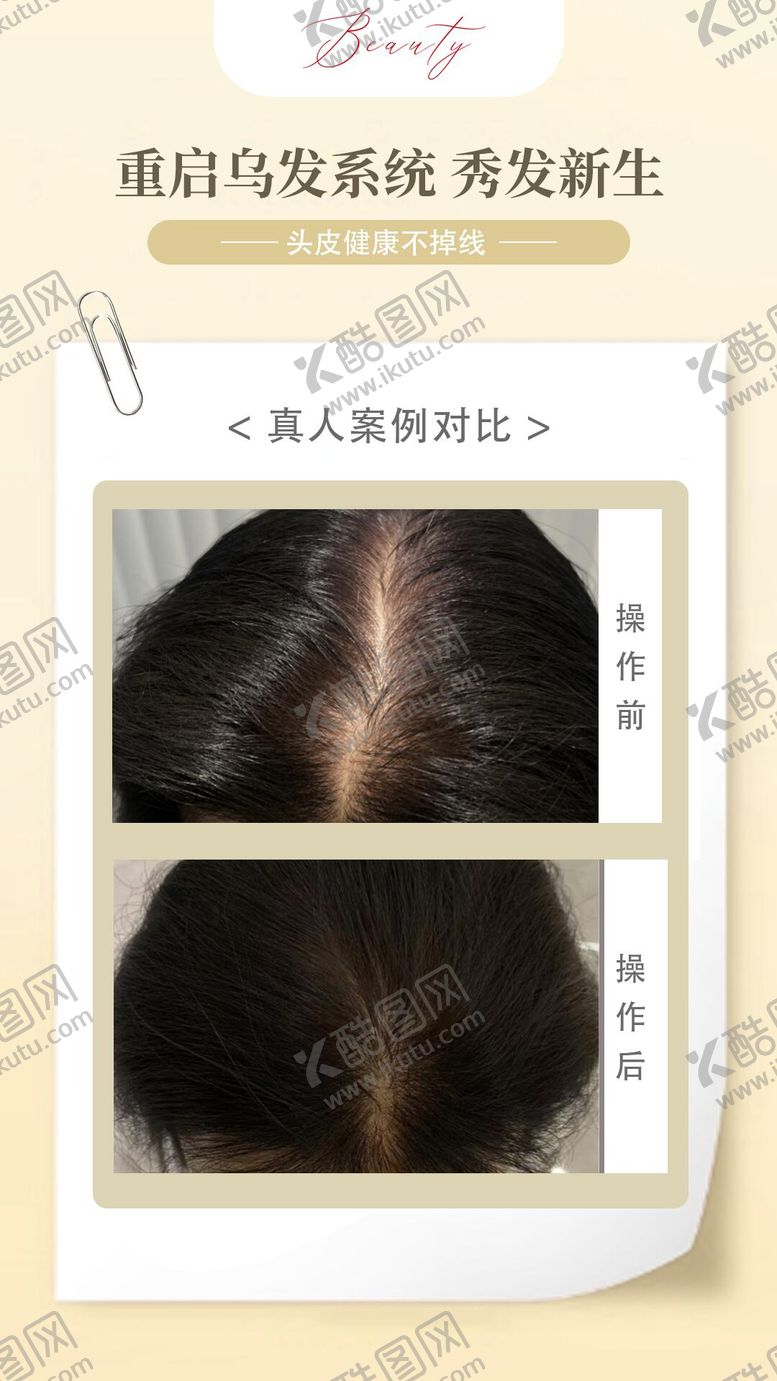 编号：68680606051806425811【酷图网】源文件下载-头皮抗衰案例海报