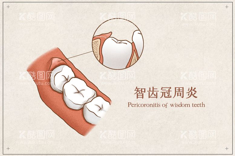 编号：05629109251306360893【酷图网】源文件下载-智齿冠周炎