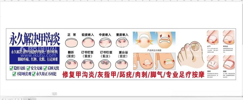 编号：26210002260858329819【酷图网】源文件下载-甲沟炎海报灯箱