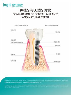 口腔种植牙于天然牙对比