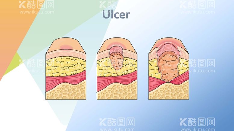 编号：30018111111927181921【酷图网】源文件下载-溃疡