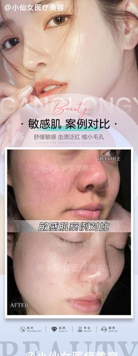 皮肤医美敏感肌案例对比海报